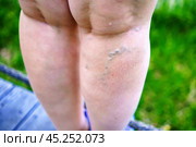 Swollen veins on the leg of a well-fed woman. Стоковое фото, фотограф Татьяна Степанищева / Фотобанк Лори