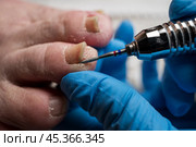 Professional hardware pedicure, ingrown toenail, elderly woman with cracked skin on her foot at a podiatrist's appointment, chiropody and podology concept. Стоковое фото, фотограф Станислав Тарко / Фотобанк Лори