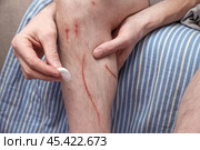 Мужчина обрабатывает свои царапины антисептическим ватным тампоном. свежие раны от кошачьих когтей. повреждена голень человека, дезинфекция. Стоковое фото, фотограф Дмитрий Кобзев / Фотобанк Лори