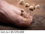 Грибки растут из ногтевых пластин на стопе. Концепция о грибке ногтей, кожных и ногтевых инфекциях. Стопа с грибком крупным планом на фоне деревянного пола. Стоковое фото, фотограф Александр Маликов / Фотобанк Лори