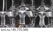 MRI lumbar spine background, magnetic resonance tomography. Doctor examines MRI of lumbar spine with pinched discs of spine and nerves. Стоковое видео, видеограф Андрей Армягов / Фотобанк Лори