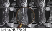 MRI lumbar spine background, magnetic resonance tomography. Doctor examines MRI of lumbar spine with pinched discs of spine and nerves. Стоковое видео, видеограф Андрей Армягов / Фотобанк Лори