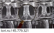 MRI lumbar spine background, magnetic resonance tomography. Doctor examines MRI of lumbar spine with pinched discs of spine and nerves. Стоковое видео, видеограф Андрей Армягов / Фотобанк Лори