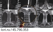 MRI lumbar spine background, magnetic resonance tomography. Doctor examines MRI of lumbar spine with pinched discs of spine and nerves. Стоковое видео, видеограф Андрей Армягов / Фотобанк Лори