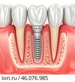 Dental implant successfully replacing missing tooth, 3d illustration. Стоковое AI-изображение, AI-художник Иван Рябоконь / Фотобанк Лори