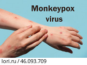 Phrase MONKEYPOX VIRUS on blue background and Patient with Monkey Pox. Monkeypox new disease dangerous over the world. Painful rash, red spots blisters. Close up human hands with Health problem. Стоковое фото, фотограф Марина Демидюк / Фотобанк Лори