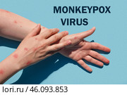 Phrase MONKEYPOX VIRUS on blue background and Patient with Monkey Pox. Monkeypox new disease dangerous over the world. Painful rash, red spots blisters. Close up human hands with Health problem. Стоковое фото, фотограф Марина Демидюк / Фотобанк Лори