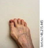 Подногтевая гематома через 6 месяцев после травмы ноги тесной обувью. Skier’s Toe is characterised by bleeding under the nail bed. The medical term for a Skier’s Toe is a Subungual Haematoma. Subungual hematoma 6 months after a leg injury from tight shoes. The effect of wearing uncomfortable shoes. Pedicure and podiatry. Medicine concept foot isolated on white. Стоковое фото, фотограф Iva Noel / Фотобанк Лори