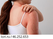 Woman with red sunburned skin against light background, closeup. Стоковое фото, фотограф Pixel_shot / Фотобанк Лори