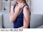 Young woman with bruised arms sitting on sofa at home, closeup. Стоковое фото, фотограф Pixel_shot / Фотобанк Лори