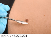 Doctor with lancet going to remove mole from patient's skin, closeup. Стоковое фото, фотограф Pixel_shot / Фотобанк Лори
