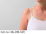 Woman with red sunburned skin against light background, closeup. Стоковое фото, фотограф Pixel_shot / Фотобанк Лори