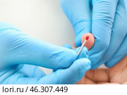 Doctor using lancet to get blood sample for test, closeup. Стоковое фото, фотограф Pixel_shot / Фотобанк Лори