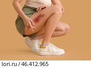 Young woman with bruised leg on beige background. Стоковое фото, фотограф Pixel_shot / Фотобанк Лори