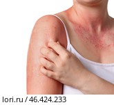 Woman with red sunburned skin against white background, closeup. Стоковое фото, фотограф Pixel_shot / Фотобанк Лори