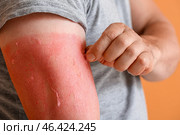 Man with red sunburned skin against color background, closeup. Стоковое фото, фотограф Pixel_shot / Фотобанк Лори