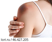 Young woman with bruised shoulder on white background, closeup. Стоковое фото, фотограф Pixel_shot / Фотобанк Лори