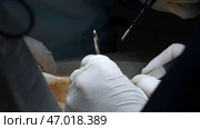 Close up of process of the real surgery at the hospital. Стоковое фото, фотограф David Kashakhi / Фотобанк Лори