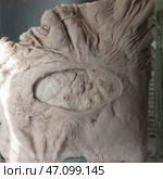 April 1, 2023. Belarus, Minsk. Exhibition of anatomical exhibits. The stomach organ of a person with a perforated ulcer is an anatomical exhibit preserved in alcohol in a formaldehyde solution. Редакционное фото, фотограф Лазаренко Светлана / Фотобанк Лори