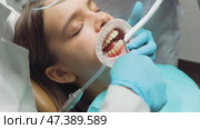 Dentist rinsing off etching gel from patients teeth during aligner bonding procedure in orthodontic clinic. Стоковое видео, видеограф Дмитрий Наумов / Фотобанк Лори
