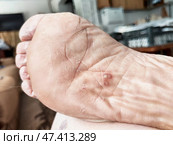 Characteristics and symptoms of foot fungus affecting the skin and nails in a domestic setting. Стоковое фото, фотограф Кривошеина Елена Леонидовна / Фотобанк Лори