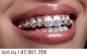 Braces on clean teeth. beautiful girls lips. Брекеты на зубах. Красивые губы девушки. Стоковое AI-изображение, AI-художник Katsiaryna Repich / Фотобанк Лори