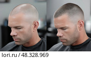 Scalp Micropigmentation Before/After, Side View of Thinning Hair vs Filled Hairline in Barber shop. Микропигментация кожи головы до и после, вид сбоку на поредевшие волосы и заполненную линию волос в парикмахерской. Стоковое AI-изображение, AI-художник Katsiaryna Repich / Фотобанк Лори