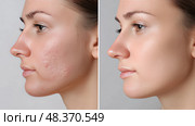 Acne Treatment Before/After, Red Irritated Skin vs. Clear Smooth Complexion. Лечение акне до и после, красная раздраженная кожа против чистой гладкой кожи. Стоковое AI-изображение, AI-художник Katsiaryna Repich / Фотобанк Лори