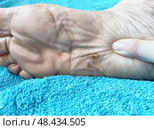 Foot fungus affecting the sole, observed during a health examination outdoors in a clinical setting. Стоковое фото, фотограф Кривошеина Елена Леонидовна / Фотобанк Лори