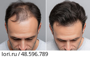 Hair Loss Before After Frontal and Crown Restoration. Выпадение волос до и после восстановления лобной и коронной части головы. Стоковое AI-изображение, AI-художник Katsiaryna Repich / Фотобанк Лори