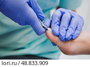 Профессиональный педикюр с использованием корректирующей скобы. Врач-подолог лечит вросший ноготь пациента, обрезает лишнее щипчиками. Стоковое фото, фотограф Катерина Бондарец / Фотобанк Лори