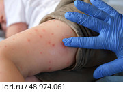 Doctor examining child with bodily red rash. Kid allergy closeup. Little baby scratches an eruption. Nurse applies special cream to atopic skin. Dermatitis, irritation, hive. Pruritus. Mosquito bites. Стоковое фото, фотограф Марина Демидюк / Фотобанк Лори