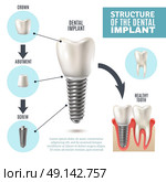 Dental Implant Structure Medical Infographic Poster . Dental implant structure medical pictorial educative infographic poster with molar replacement end healthy tools models vector illustration . Стоковая иллюстрация, агентство Ingram Publishing / Фотобанк Лори