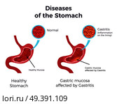 Gastritis Stomach Set. Стоковая иллюстрация, агентство Ingram Publishing / Фотобанк Лори