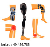 Pain in joints and orthopedic retainers on legs colorful vector illustration with white human s bones, red dots of ache surfaces, medical prosthesis. Pain in Joints and Orthopedic Retainers on Legs. Стоковая иллюстрация, агентство Ingram Publishing / Фотобанк Лори