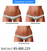 Surgical suture stitches realistic composition with isolated images of realistic female body and editable text captions vector illustration. Стоковая иллюстрация, агентство Ingram Publishing / Фотобанк Лори