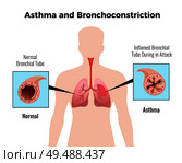 Asthma attack medical educative chart poster with depiction of normal and inflamed bronchial tube flat vector illustration. Стоковая иллюстрация, агентство Ingram Publishing / Фотобанк Лори