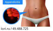 Surgical suture stitches realistic appendicitis composition with view of surgical intervention mark on realistic female body vector illustration. Стоковая иллюстрация, агентство Ingram Publishing / Фотобанк Лори