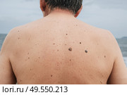 The back of an elderly man with freckles, aging spots, black, brown warts and wrinkles. Стоковое фото, фотограф Корчагина Анастасия / Фотобанк Лори
