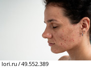 Close-up skin texture with red pimples, irritation and clogged pores, which indicates dermatological problems with skin care. Hormonal acne and spots on the face. Стоковое фото, фотограф Корчагина Анастасия / Фотобанк Лори