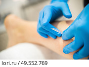 Close-up of a needle and hands of physiotherapist doing a dry needling in a physiotherapy center.. Hands of physiotherapist doing a dry needling. Стоковое фото, агентство Ingram Publishing / Фотобанк Лори