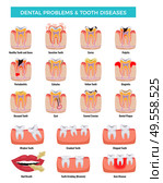 Dental oral problems educational infographic set with caries inflammation tooth plaque bad breath enamel erosion vector illustration. Стоковая иллюстрация, агентство Ingram Publishing / Фотобанк Лори