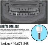Clipping from article about dental implants. Black and white x-ray of human jaw with normal teeth and prosthesis above text about dental implant. Treatment, dentistry, care. Radiograph with prosthesis. Clipping from article about dental implants. X-ray of human jaw with healthy teeth and prosthesis. Стоковая иллюстрация, агентство Ingram Publishing / Фотобанк Лори