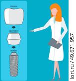 Female doctor talking about dental prosthesis structure. Implantation dentistry, stomatology. Tooth care, treatment. Dental implant creation scheme. Sequence of connection of screw, abutment and crown. Female doctor talking about prosthesis structure. Dentist works with dental implant creation scheme. Стоковая иллюстрация, агентство Ingram Publishing / Фотобанк Лори