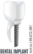 Realistic white dental implant and human tooth. Dentistry, medicine and oral cavity health concept. Denture construction, dental prosthesis structure. Information banner about teeth and implants. Realistic white dental implant and human tooth. Dentistry, medicine and oral cavity health. Стоковая иллюстрация, агентство Ingram Publishing / Фотобанк Лори