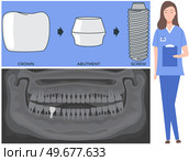 Female doctor talking about dental prosthesis structure. Implantation dentistry, stomatology. Tooth care, treatment. Dental implant creation scheme. Sequence of connection of screw, abutment and crown. Female doctor talking about prosthesis structure. Dentist works with dental implant creation scheme. Стоковая иллюстрация, агентство Ingram Publishing / Фотобанк Лори