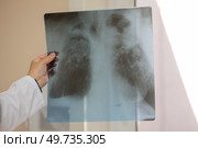X-ray analysis of human lungs, doctor examines lung disease. Pneumonia. X-rays of light. Стоковое фото, фотограф Лазаренко Светлана / Фотобанк Лори