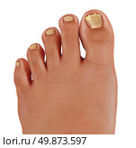 ToeNail fungus close up with a human foot with infected toe nails as a symbol of treating and diagnosing feet with a fungal diseases in the medical field of podiatry isolated on a white background. Стоковое фото, агентство Ingram Publishing / Фотобанк Лори