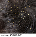 Head lice medical concept with a close up of a human head with an infestation of parasitic nits or eggs hatching near the scalp from a louse as a symbol of  diagnosis prevention and treatment for children and adults. Стоковое фото, агентство Ingram Publishing / Фотобанк Лори