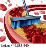 Cleaning arteries concept as a broom removing plaque buildup in a clogged artery as a symbol of  atherosclerosis disease medical treatment opening clogged veinswith blood cells as a metaphor for removing cholesterol as an icon of vascular diseases. Стоковое фото, агентство Ingram Publishing / Фотобанк Лори